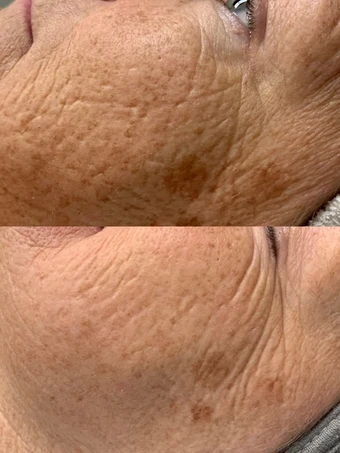 Skin before and after a Personalized Hybrid Treatment at Radiant Glow Skin Spa