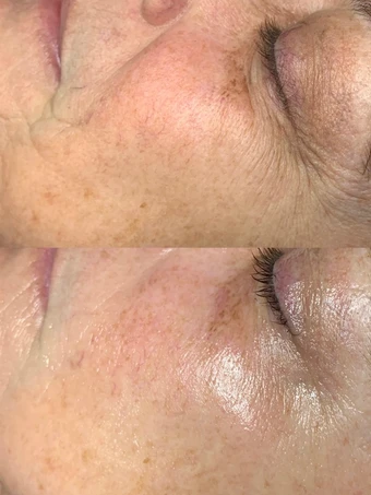 Skin texture before and after a Nano Facial w/ Peel at Radiant Glow Skin Spa