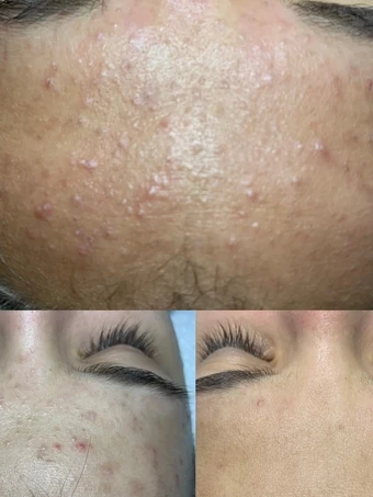 Teen acne skin before and after treatment at Radiant Glow Skin Spa